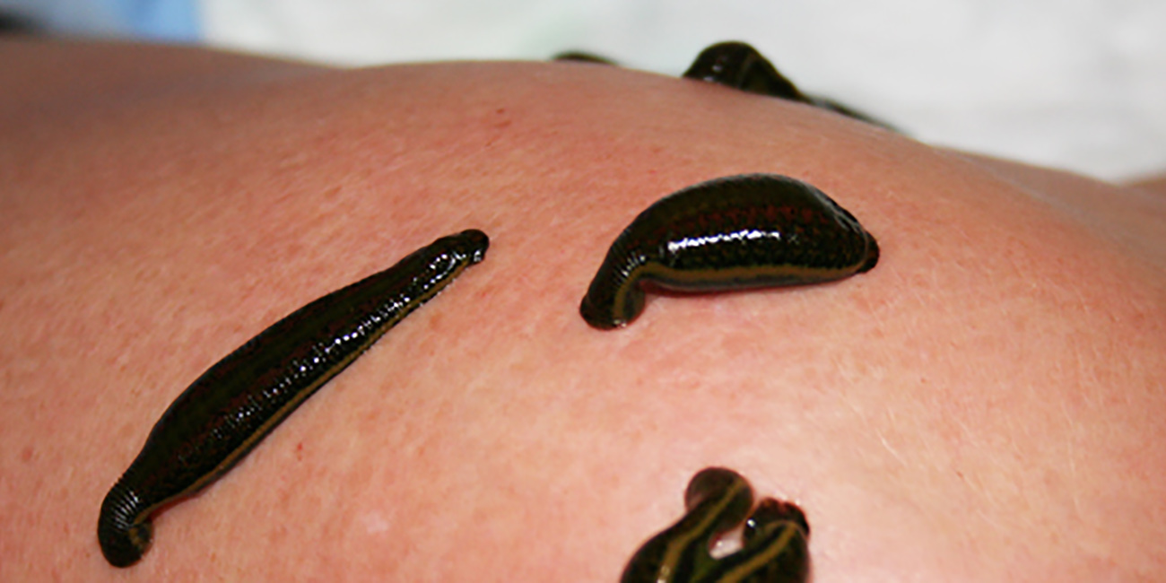 leech therapy